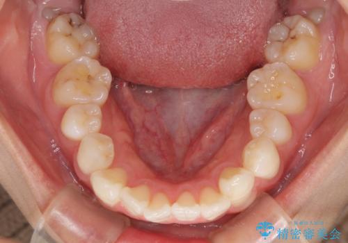 【モニター】気になる八重歯を素早く改善 ワイヤー装置での抜歯矯正の治療前