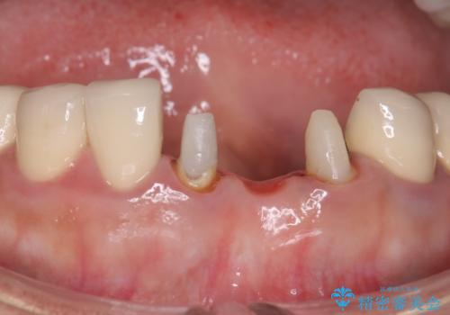 前歯が一本取れた オールセラミックブリッジによる補綴治療の治療中