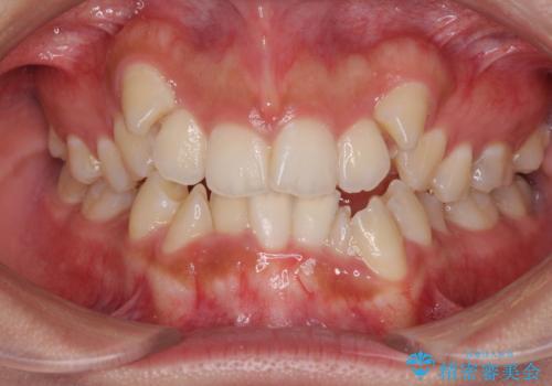 著しい八重歯が気になる　インビザラインでの矯正治療の症例 治療前
