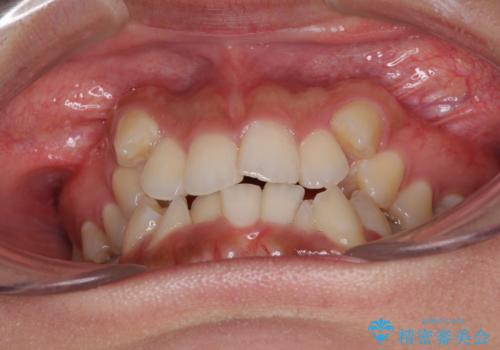 著しい八重歯が気になる インビザラインでの矯正治療の治療前