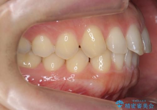前歯の目立ったすき間 マウスピース矯正で目立たなくしますの治療前