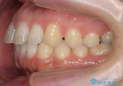 前歯の目立ったすき間 マウスピース矯正で目立たなくしますの治療前