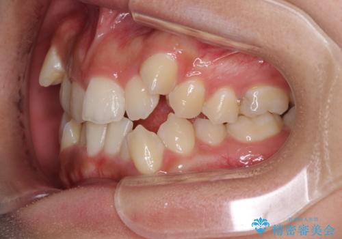著しい八重歯が気になる インビザラインでの矯正治療の治療前