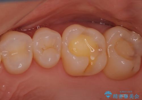 目立つ銀歯を白くしたい セラミック治療の治療中