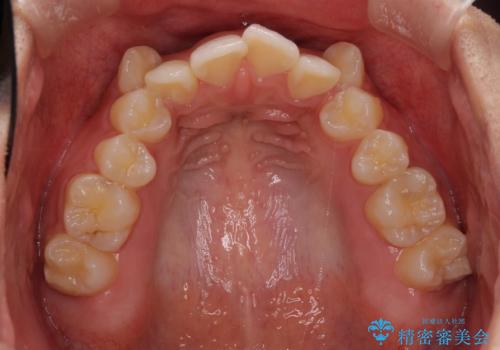 著しい八重歯が気になる　インビザラインでの矯正治療の治療前