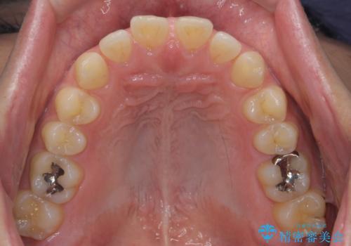 前歯の目立ったすき間 マウスピース矯正で目立たなくしますの治療前