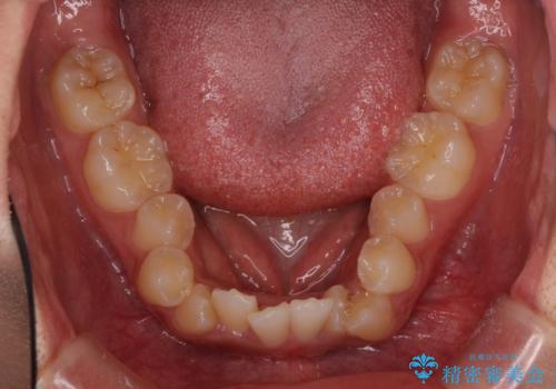 著しい八重歯が気になる インビザラインでの矯正治療の治療前