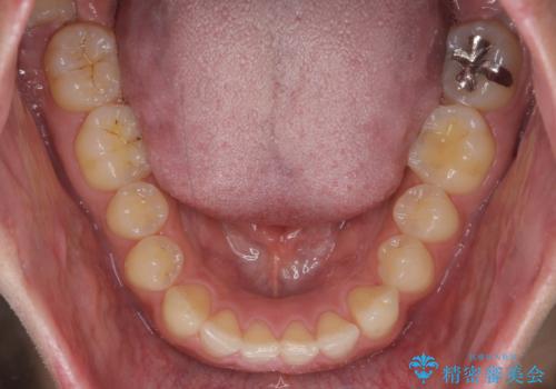前歯の目立ったすき間 マウスピース矯正で目立たなくしますの治療前