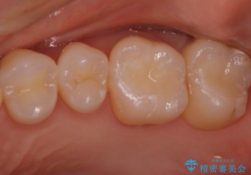 目立つ銀歯を白くしたい　セラミック治療の治療後