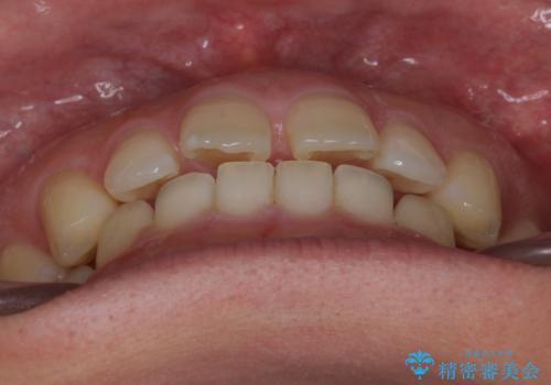 前歯の目立ったすき間 マウスピース矯正で目立たなくしますの治療前