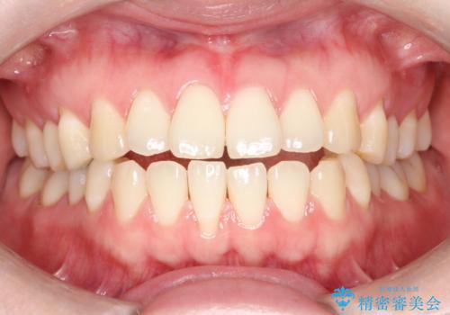 上下の前歯がかめない インビザライン矯正で正しいかみ合わせへ