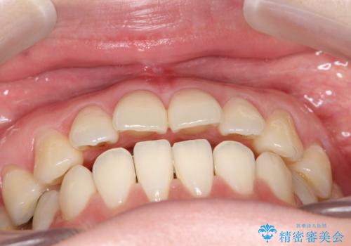 上下の前歯がかめない インビザライン矯正で正しいかみ合わせへの治療前