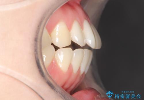 上下の前歯がかめない インビザライン矯正で正しいかみ合わせへの治療前