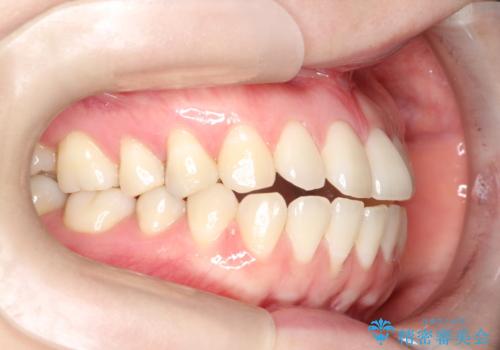 上下の前歯がかめない インビザライン矯正で正しいかみ合わせへの治療前