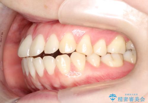 上下の前歯がかめない インビザライン矯正で正しいかみ合わせへの治療前