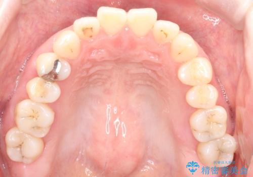 上下の前歯がかめない インビザライン矯正で正しいかみ合わせへの治療前