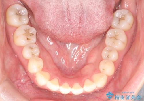 上下の前歯がかめない インビザライン矯正で正しいかみ合わせへの治療前