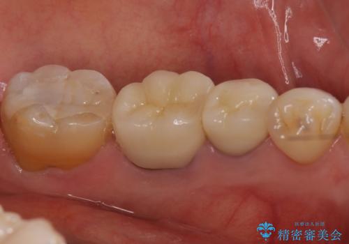 下の銀歯をセラミックに　虫歯治療の治療後