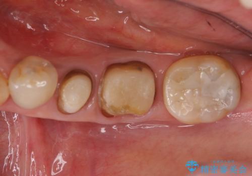 下の銀歯をセラミックに 虫歯治療の治療中