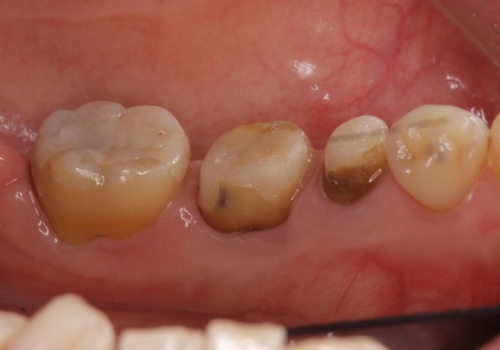下の銀歯をセラミックに　虫歯治療の治療中