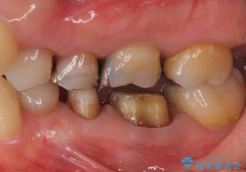 下の銀歯をセラミックに 虫歯治療の治療中