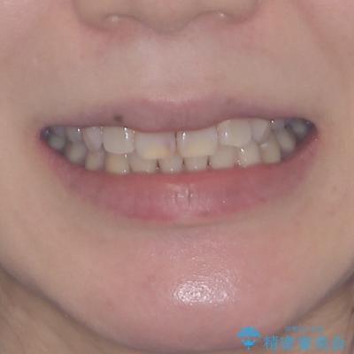 気になる八重歯を目立たない装置で改善　ハーフリンガル矯正の治療後（顔貌）