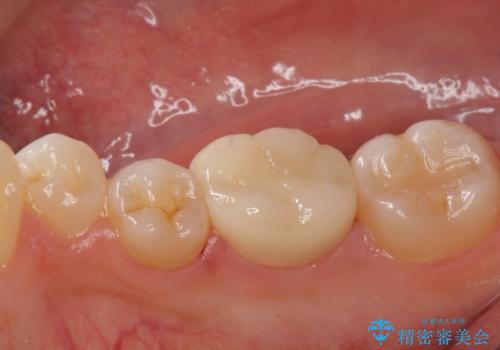 以前入れた詰め物が欠けたの治療後