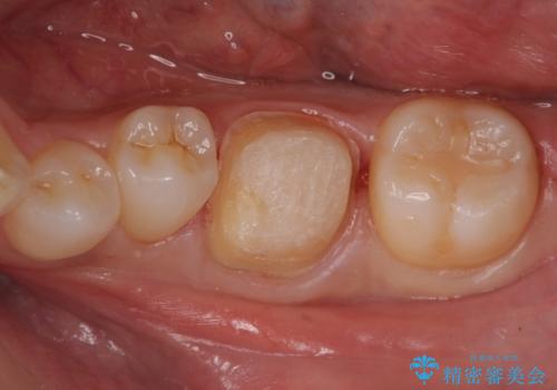 以前入れた詰め物が欠けたの治療中
