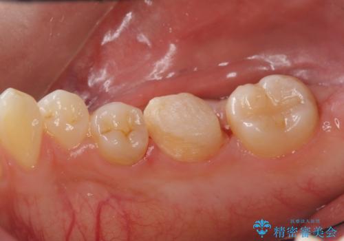 以前入れた詰め物が欠けたの治療中
