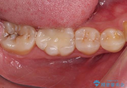 目立つ銀歯を白くしたい セラミック治療の治療後