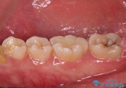 目立つ銀歯を白くしたい セラミック治療の治療後