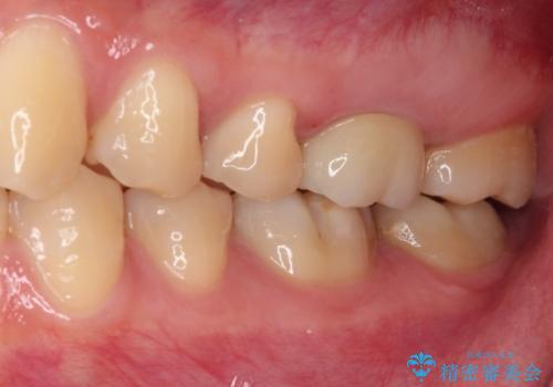 目立つ銀歯を白くしたい セラミック治療の治療後