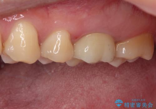 目立つ銀歯を白くしたい　セラミック治療の治療後