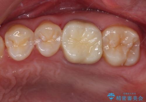 目立つ銀歯を白くしたい　セラミック治療