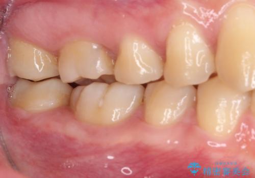 目立つ銀歯を白くしたい セラミック治療の治療後