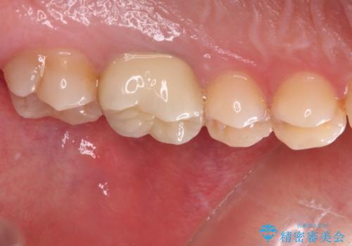 目立つ銀歯を白くしたい セラミック治療の治療後