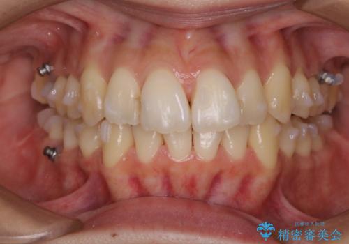 PMTCの30分コースの治療後