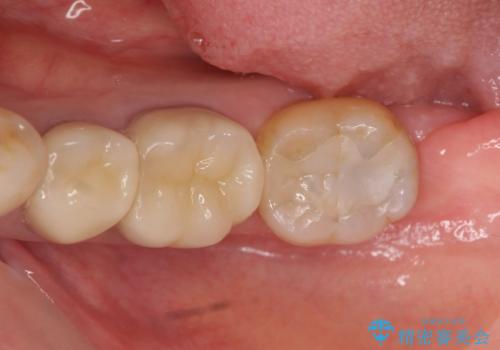 下の銀歯をセラミックに　虫歯治療の症例 治療後
