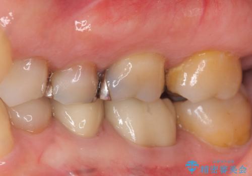 下の銀歯をセラミックに 虫歯治療の治療後
