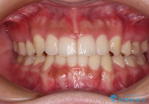 著しい八重歯が気になる　インビザラインでの矯正治療の治療中