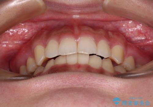 著しい八重歯が気になる インビザラインでの矯正治療の治療中