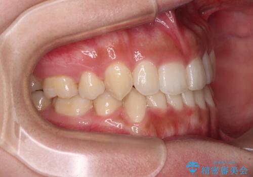 著しい八重歯が気になる インビザラインでの矯正治療の治療中