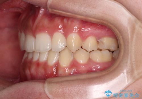 著しい八重歯が気になる　インビザラインでの矯正治療の治療中