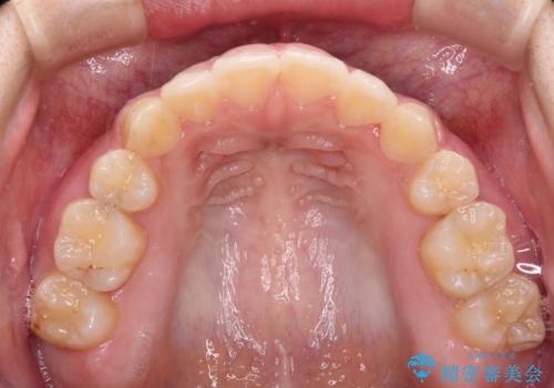 著しい八重歯が気になる インビザラインでの矯正治療の治療中