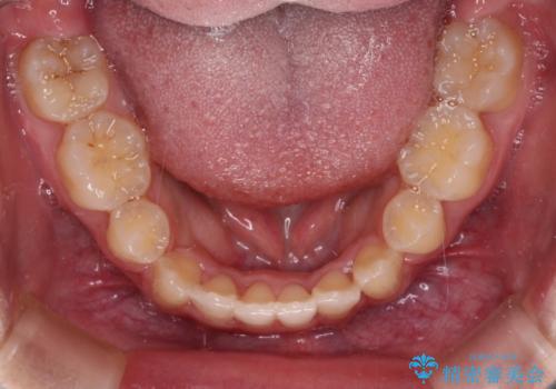 著しい八重歯が気になる インビザラインでの矯正治療の治療中