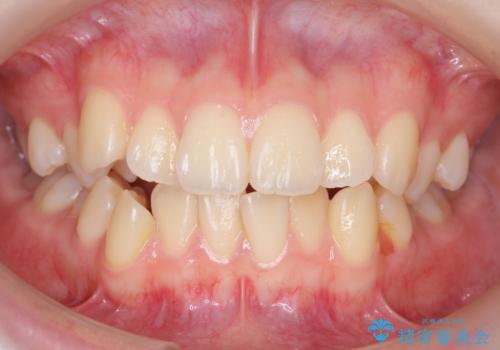 下の八重歯　歯を抜かずに　インビザライン治療の症例 治療前