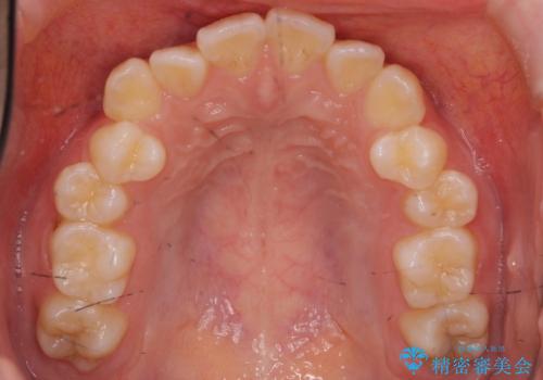 下の八重歯　歯を抜かずに　インビザライン治療の治療前