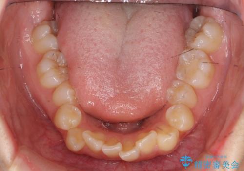 下の八重歯　歯を抜かずに　インビザライン治療の治療前