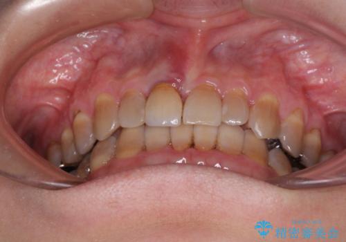 咬み合わせを治したい インビザラインによる矯正治療の治療中