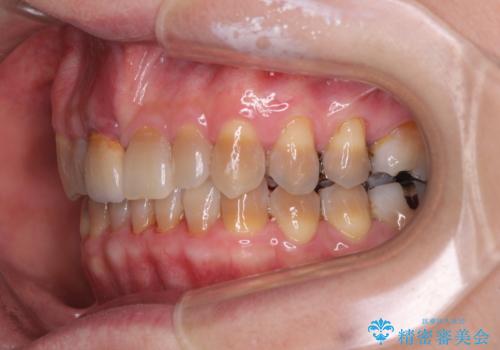 咬み合わせを治したい インビザラインによる矯正治療の治療中